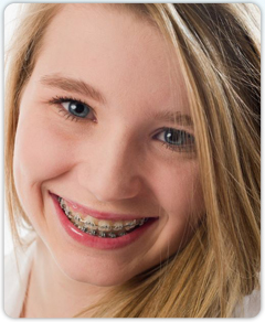 clarity ceramic brackets