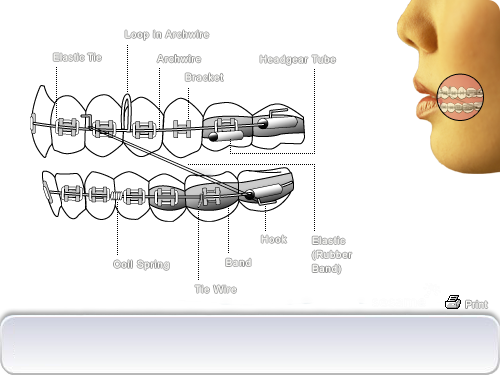 Clear Braces Holliston, MA, Adult Orthodontics